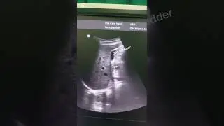 liver and gall bladder scan #medico #cirrosis #gallstones #abdominal #abdominalultrasound