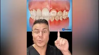 Braces Life Hack! How To Not Get White Spots With Braces!