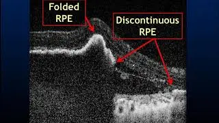 RPE Rip: Noninvasive detection