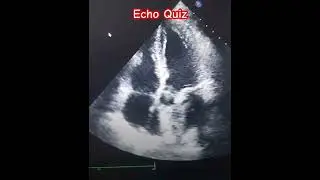 #echocardiography #echo #heartmonitoring #cardiology #heartdisease #heart @SafaMedicalLecture
