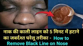 नाक की काली लाइन को हटाने का घरेलू नुस्खा | Black Line on Nose | Naak Ki Kali Line Kaise Hataye
