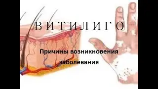 Витилиго. Витилиго причины возникновения.