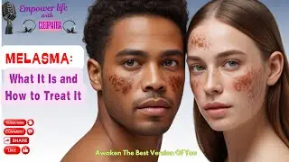 🌸 MELASMA: What It Is And How To Treat It 🌸