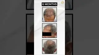 1 Year Mega Session  #baldnesssolution #fuehairtransplant  #fue #hairloss #hair