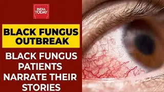 Black Fungus Outbreak In India: Black Fungus Patients Narrate Their Stories | India Today Exclusive