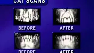 Wilckodontics&trade; - Periodontally Accelerated Osteogenic Orthodontics