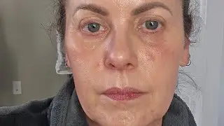 Eczema and Prednisone 