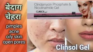 How I Achieved Clear Skin with Clindamycin Phosphate Nicotinamide Gel♡Honest Review & Results!