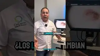 &iquest;Los lunares cambian con el tiempo? #dermatologo #lunares #cuidadodelapiel #onderm #moles