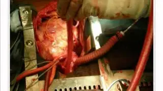 Impella 5.0 LD LP Recover 1 Trial