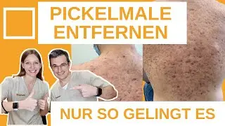 Pickelmale im Gesicht, Dekollete, Rücken und Oberarme entfernen