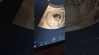الطريقة الوحيدة اللي نعرف بيها ولد ولا بنت