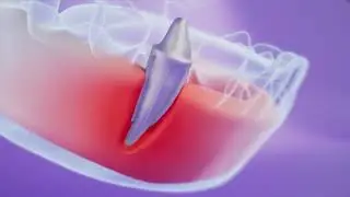 BiteOn dental implant explainer