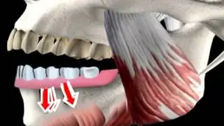 what is a hybrid prosthesis - hybrid dentures