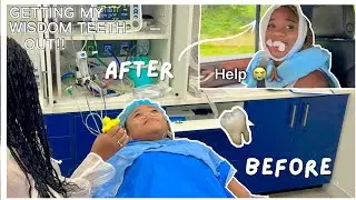 GETTING MY WISDOM TEETH REMOVED + RECOVERY UPDATE
