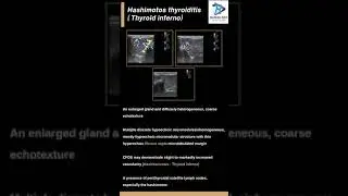 Hashimotos Thyroiditis (Thyroid inferno)