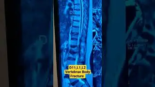 D11,L1,L2 Vertebrae Body Fracture ..Dr Sai Chandra MBBS DNB Ortho
