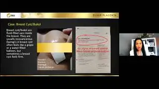 Breast Cyst or Bukol Testimony after taking Elixir Placenta