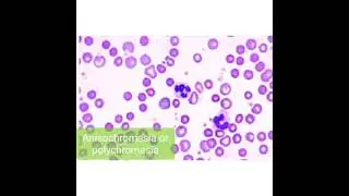 Abnormal red blood Cell