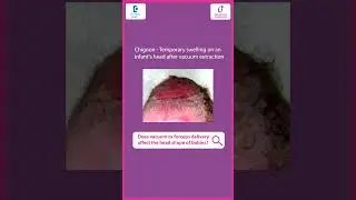 BABY HEAD SHAPE | Does Vacuum or #forceps Delivery affect head shape of #baby - Dr. Ashmina Khalsa