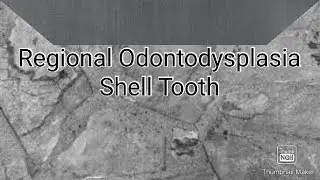 Regional Odontodysplasia + Shell Tooth