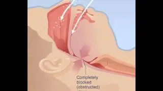 Sleep Apnea and CPAP Therapy HD Animation