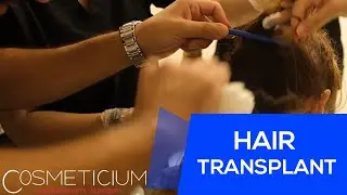 Female DHI Hair Transplantation Without Shaving