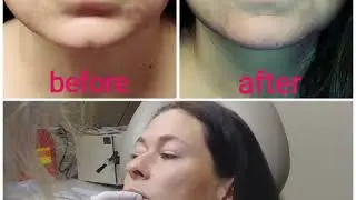Marionette Lines with Restylane Defyne New Jersey