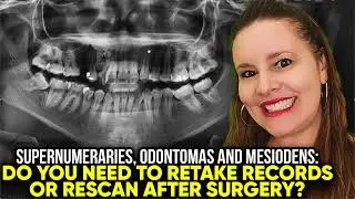 Nadliczbowy, zębiak, zębod&oacute;ł w leczeniu Invisalign: Czy konieczne jest ponowne badanie po ekstrak...