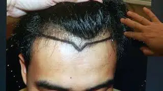 RF Hair Transplant 1-Year Follow-Up | Natural Density & Face-Framing Results by Dr. Diep
