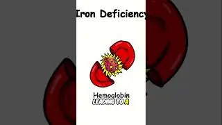 Iron Deficiency: Are YOU Part of the 30%? (Symptoms & Solutions)