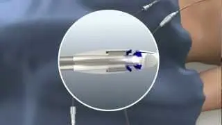 PleuraFlow - How it works