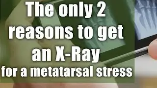 The only 2 reasons to get an X Ray for a metatarsal stress fracture