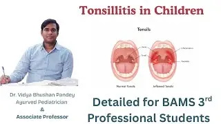 Tonsillitis in Children and management through Ayurveda 
