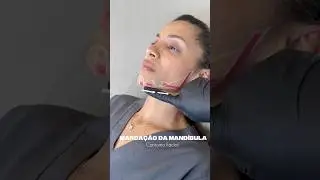 Como preencher o rosto para contorno da mand&iacute;bula e defini&ccedil;&atilde;o #preenchimento #harmonizacaofacial