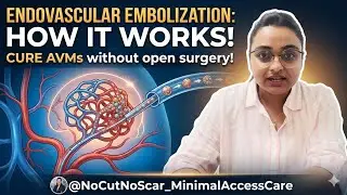Embolization of AV Malformation #InterventionalRadiology#EndovascularSurgery#AVM#PinholeSurgery