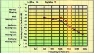AHIP - How to read an audiogram