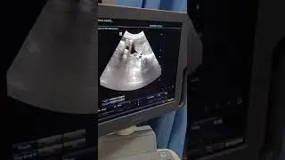 Postpartum Ascites ? Peritonitis #obglife #postpartum🤞