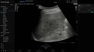 RS85 Prestige s/w v2.07. Shearwave Imaging en H&iacute;gado. TAI Y TSI para evaluar esteatosis.