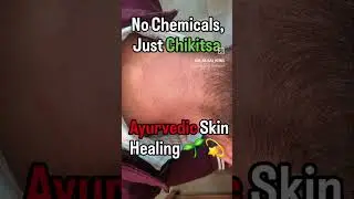 Skin Disease Case Result #ayurveda #bams #doctor #vaidya #herbal