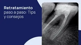 Retratamiento paso a paso: Tips y consejos