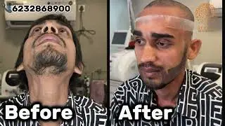 Beard Transplant patient review & experience 🤔 ।। Rootz Hair Transplant Raipur
