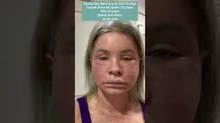 Day by day progression after facelift, C02, lip lift and browlift with before and after photos.