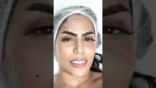 Try Botox at VLCC 🧡 #vlcc #botox #antiaging #results #skincare #wrinkles #happyclients #fillerlips