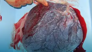 Desprendimiento prematuro de placenta