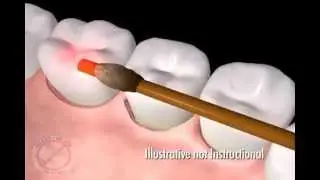 Clearwater FL Dentists Share Laser Gum Surgery Animation