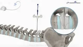SPASY- Spinal Alignment System by Seawon Meditech