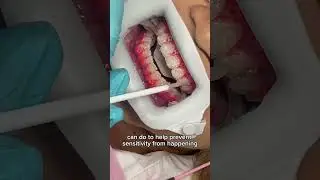 действительно ли отбеливание зубов вредит вашим зубам? 😭🦷💥