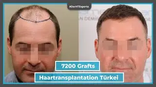 Haartransplantation Türkei ✅ Vorher - Nachher mit 7200 Grafts [Dr. Erkan Demirsoy]