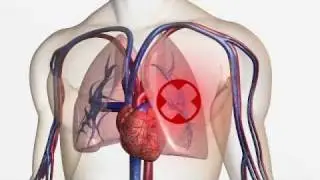 A guide to hospital-acquired deep vein thrombosis and pulmonary embolism